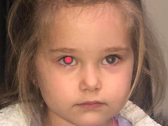 闪光灯影相得一边现红眼 澳洲4岁女被诊断出眼癌