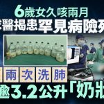 久咳两个月|6岁女童患罕见肺泡蛋白沉积症险死 双肺洗出3.2公升奶状物