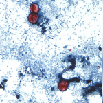 美国寄生虫疫情逾1251人感染 卫生署:未扩散至加拿大