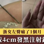 骑共享单车出事?浙女左臀剧痛1个月 自拔4cm生锈注射针头