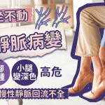 久坐不動恐靜脈病變 單腳水腫小腿變深色高危 醫生教6招改善慢性靜脈迴流不全
