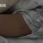 老伯被毒蛇咬伤步行1小时求医 呼吸心跳骤停……