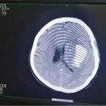 38岁女子刷手机 半边身子突然不听使唤了…